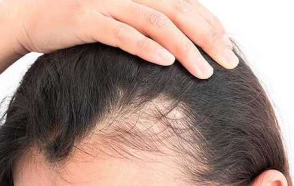 Hair loss-: What are the Different Causes of Hair Loss in Women?
